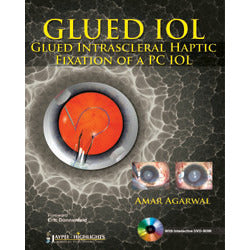 GLUED IOL GLUED INTRASCLERAL HAPTIC FIXATION OF A PC IOL WITH DVD-ROM -Agarwal-jayppe-UNIVERSAL BOOKS