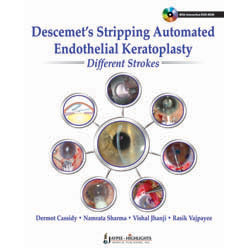 DESCEMET'S STRIPPING AUTOMATED ENDOTHELIAL KERATOPLASTY: DIFFERENT STROKES -Cassidy-jayppe-UNIVERSAL BOOKS