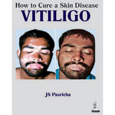 HOW TO CURE A SKIN DISEASE VITILIGO -Pasricha-jayppe-UNIVERSAL BOOKS