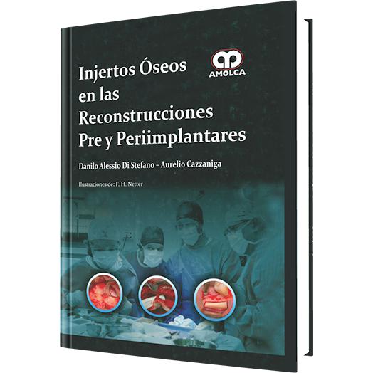 Injertos oseos en las Reconstrucciones Pre y Periimplantares-amolca-UNIVERSAL BOOKS