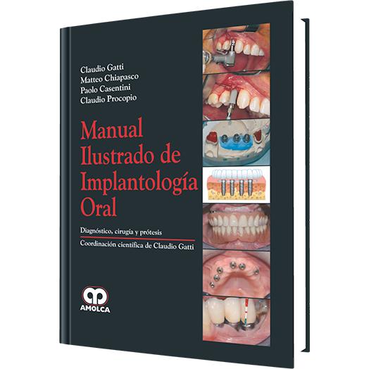 Manual Ilustrado de Implantologia oral-amolca-UNIVERSAL BOOKS