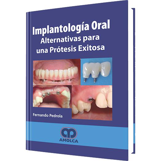 Implantologia Oral - Alternativas Para una Protesis Exitosa-amolca-UNIVERSAL BOOKS