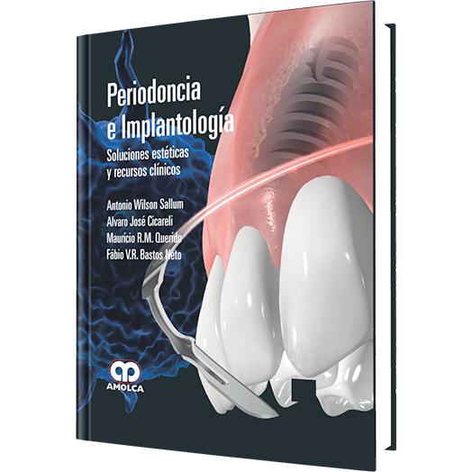 Periodoncia e Implantologia Soluciones Esteticas y Recursos Clinicos-amolca-UNIVERSAL BOOKS