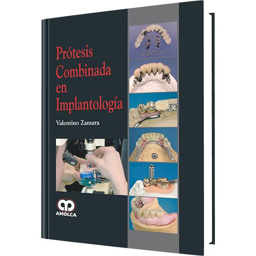 Protesis Combinada en Implantologia-REVISION - 27/01-amolca-UNIVERSAL BOOKS